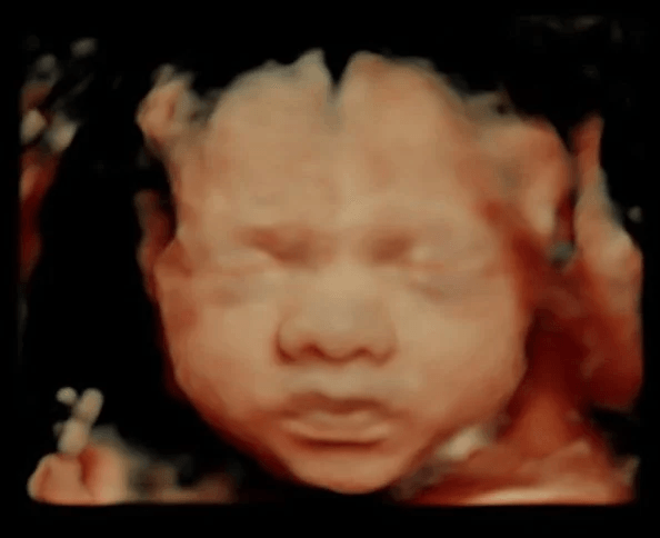 Ultrasound for Lucas - Time Traveler